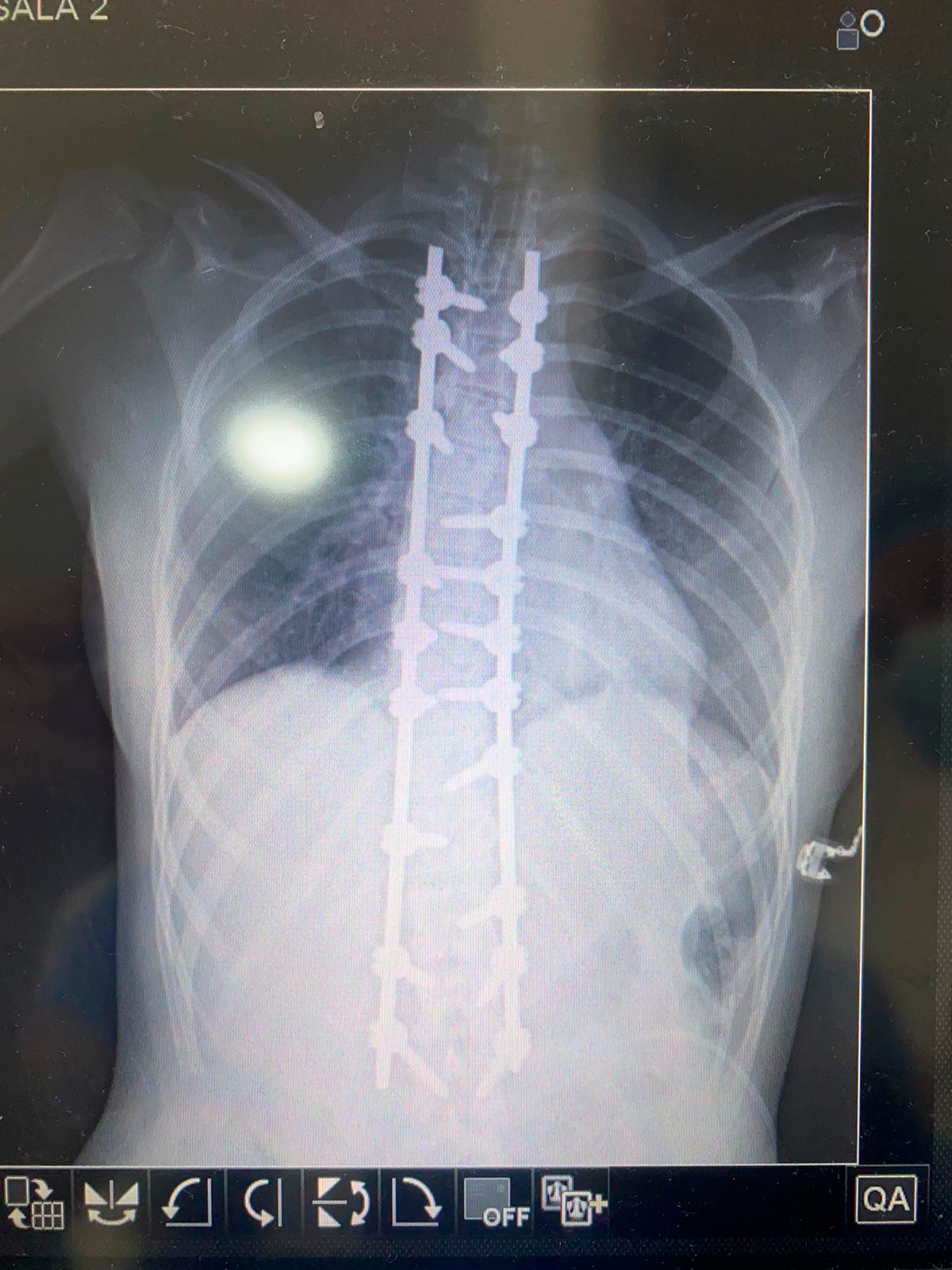 tratamiento escoliosis